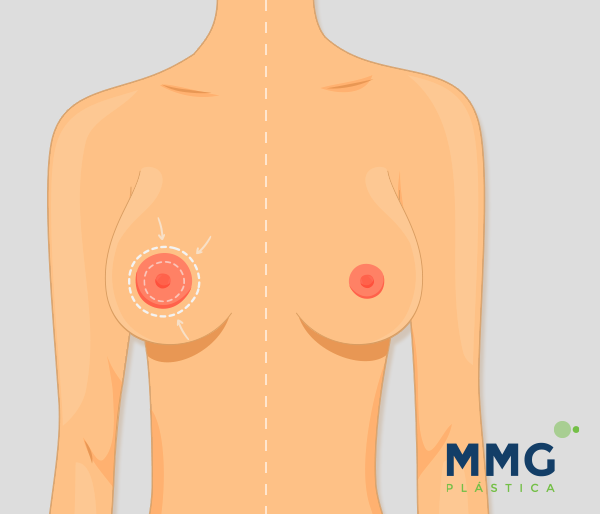 Reducción areola